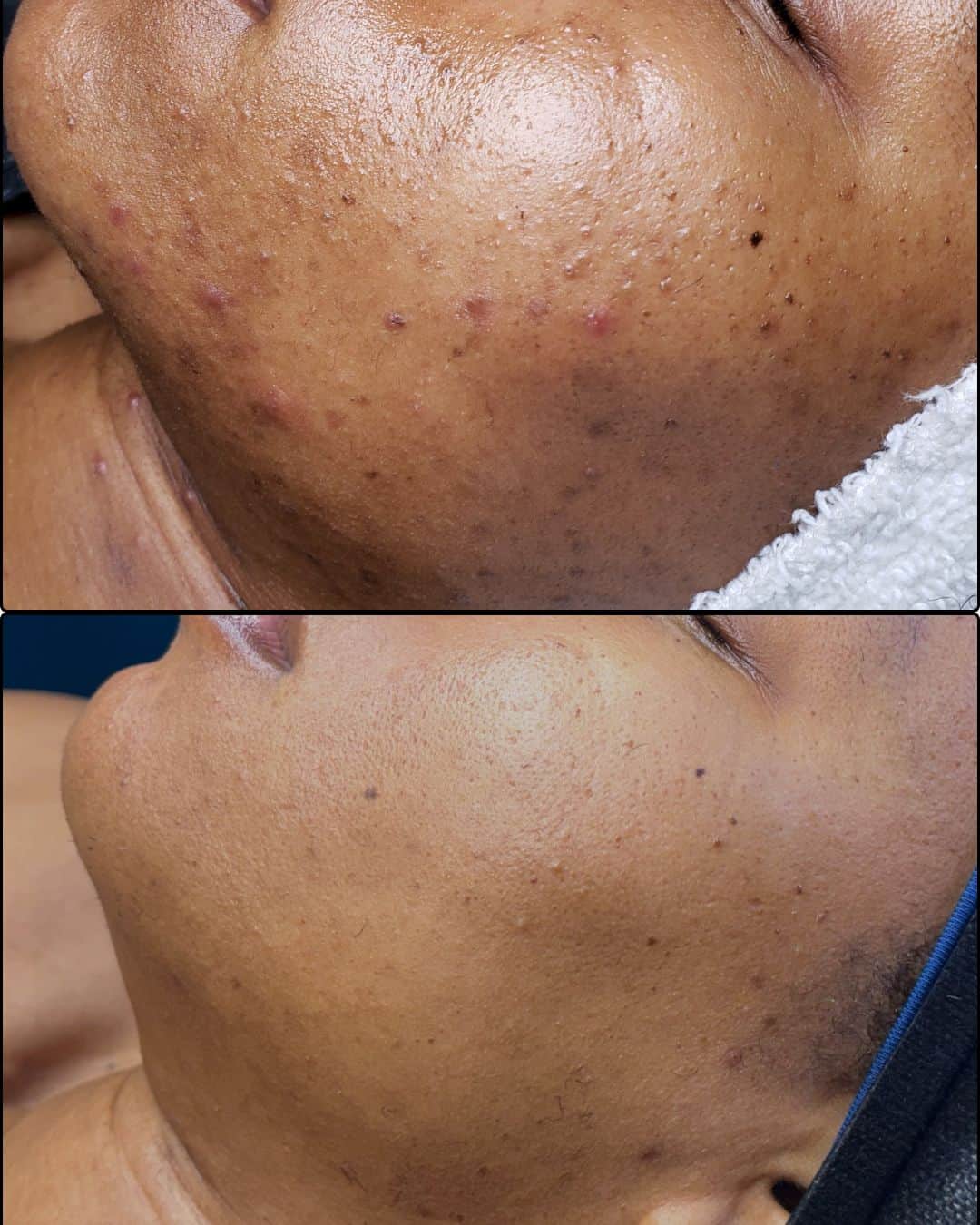 Bee Renee Aesthetics client before-and-after skincare result