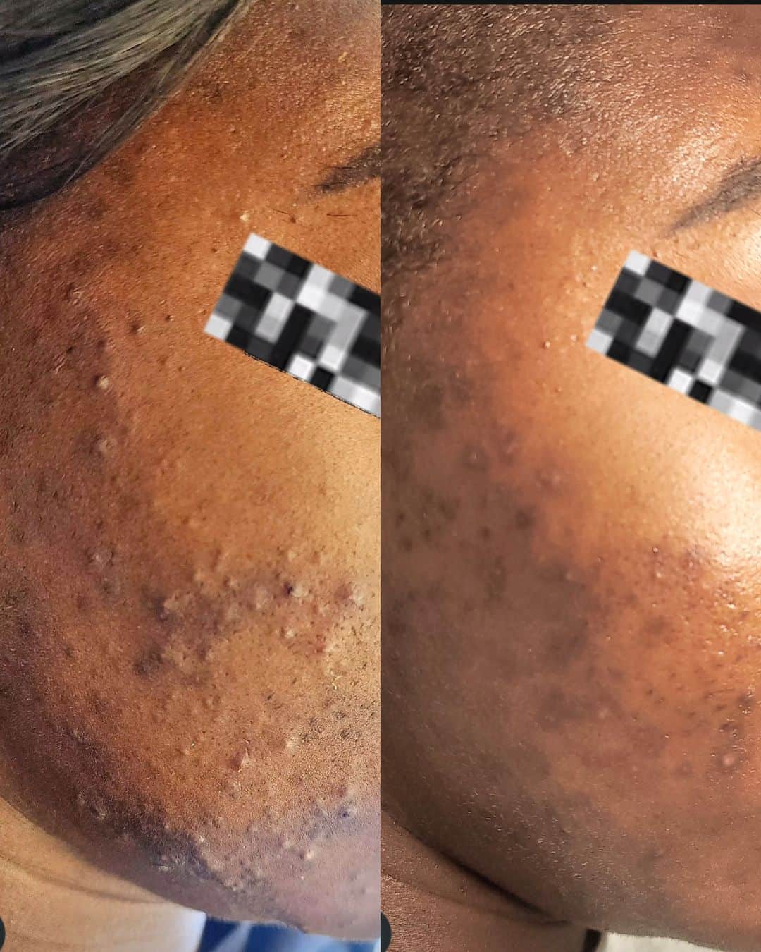 Bee Renee Aesthetics client before-and-after skincare result