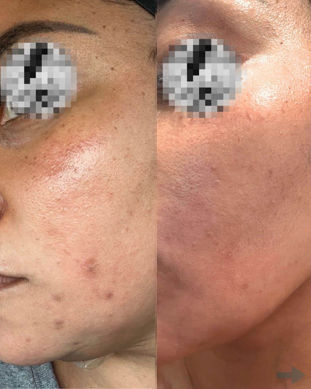 Bee Renee Aesthetics client before-and-after skincare result