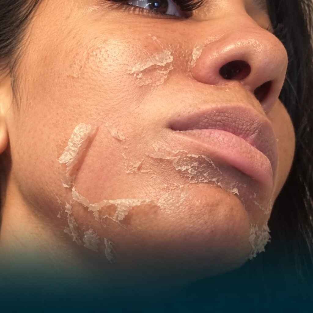 Corrective peel treatment for visible skin texture and tone at Bee Renee Aesthetics